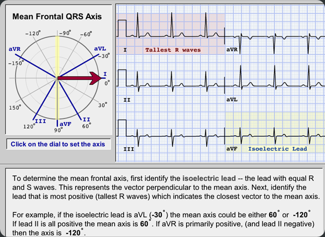 how to determine the electrical axis of the heart